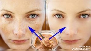 Uy sharoitida yuzdagi sepkillarni yo'qotish uchun super malham. Уй шароитида Сепкилларни йукотиш