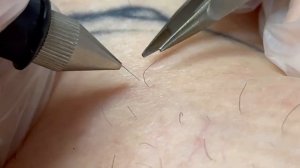 Электроэпиляция голеней