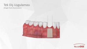 NucleOSS Easy Surgical Guide Cerrahi Set Sunumu