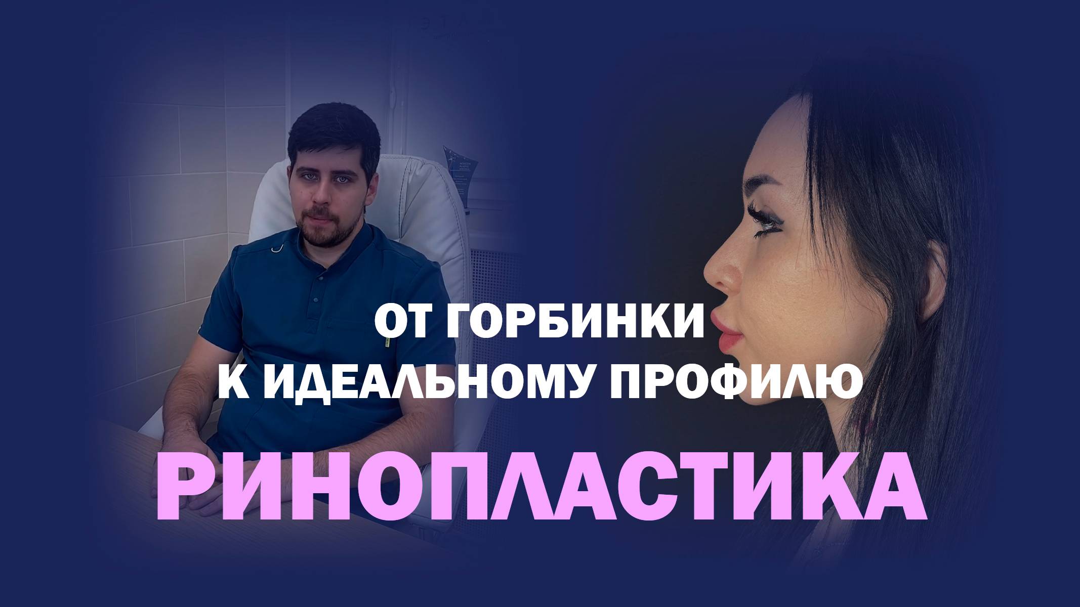 Коррекция горбинки и кончика носа: результат через 7 месяцев