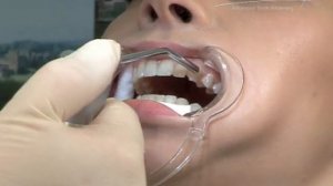 Отбеливание зубов Amazing White