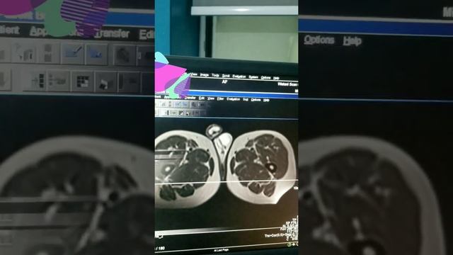 fistuola MRI magnatic c!Siemens