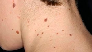 Почему появляются родинки?