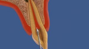 Эндо резца вертикальная конденсация