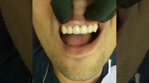 Примерка мостовидного протеза из диоксида циркония