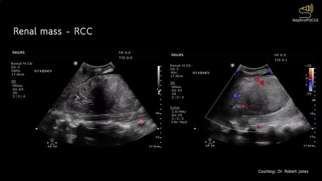Renal mass on point of care ultrasound | POCUS pearls | Dr. Koratala (@NephroP) смотреть онлайн