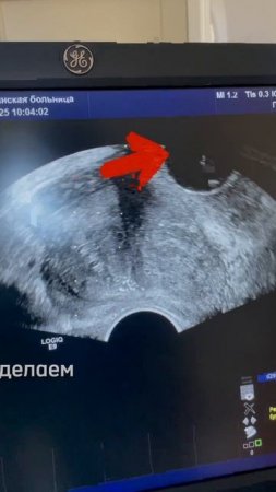 Делаю биопсию простаты. Что это такое чёрненькое на экране УЗИ аппарата?