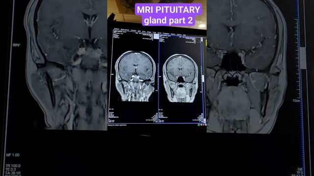 MRI BRAIN dynamic PITUITARY gland #doctor #mri #medicalimaging #hospital #radiologist #mbbs #viral