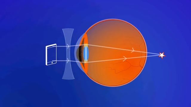 《健力視近視防控》Myopia glasses may not solve the problem of Nearsightedness смотреть онлайн