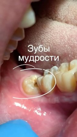 📛 Зубы мудрости