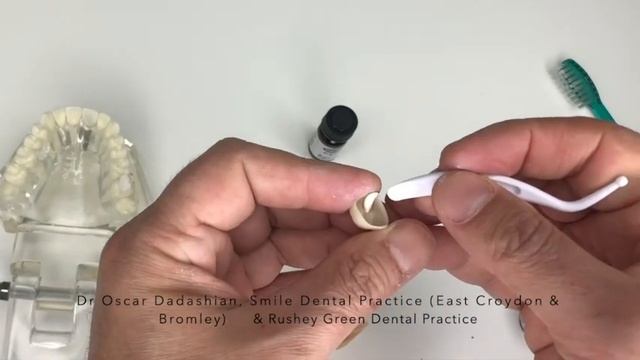 Re-cementing or re-fixing a crown or bridge смотреть онлайн