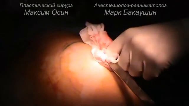 Маммопластика (увеличение груди). Пластический хирург Максим Осин. Общая анестезия. смотреть онлайн