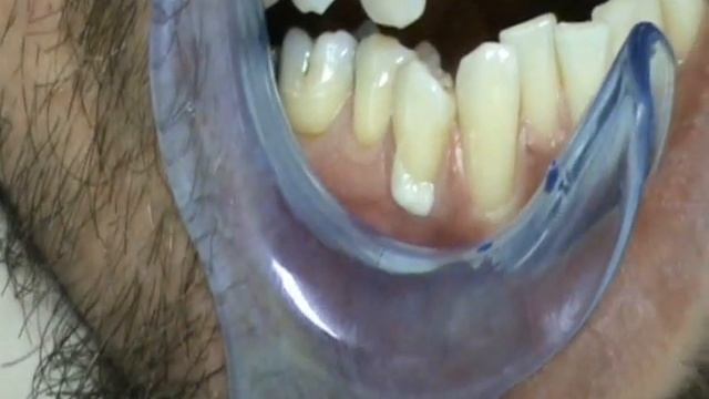 Minimalno invazivna resturacija V klase ( fuji VIII ).wmv смотреть онлайн