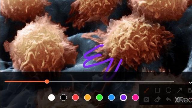 WBCs Disorders PATHOMA 4 | Chronic Leukemia смотреть онлайн