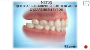 Дистальная окклюзия с протрузией