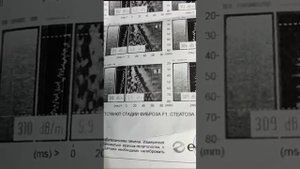 Хемохим. Исцеление. Фиброз печени F2. Отзыв из Дагестана