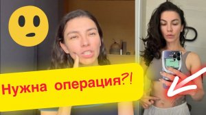 Последствия родов | Почему не убрали грыжу | пупочная грыжа | грыжа после родов #грыжа #роды #дети