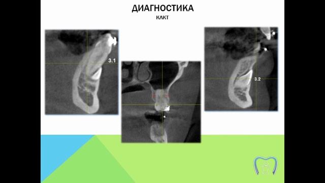 Перекрестная окклюзия