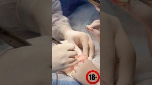 БЕСКРОВНОЕ ЭСТЕТИЧЕСКОЕ ОБРЕЗАНИЕ