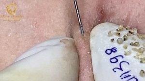 Blackheads extraction and pimple popping (398) | Loan Nguyen