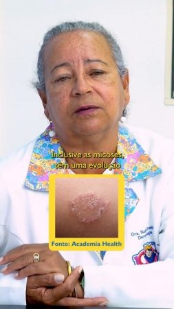 Bicho geográfico, micose ou bicho de pé?