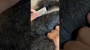 Extreme Dandruff!! | 2month old braid take down flakes!!!