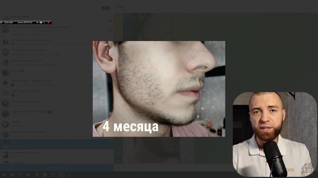 Миноксидил результаты До и После. Андрей Борода Выпуск №21 Как запустить рост бороды