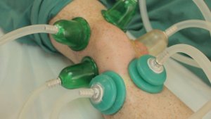 Устранение болевого синдрома в коленном суставе с помощью вакуумного массажа medbanki.ru