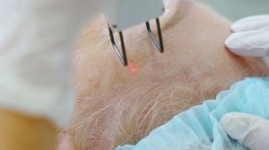 Фракционное лазерное омоложение (шлифовка) на аппарате Smart Xide DOT CO2