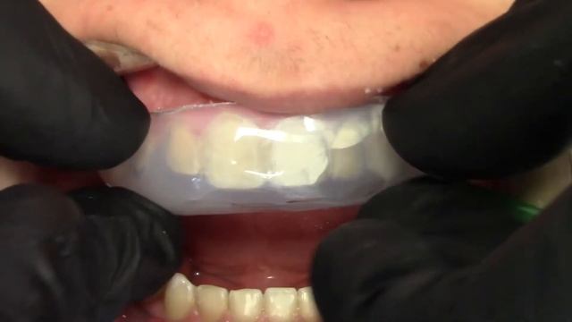 Reconstrucción dental con llave de silicona transparente. смотреть онлайн