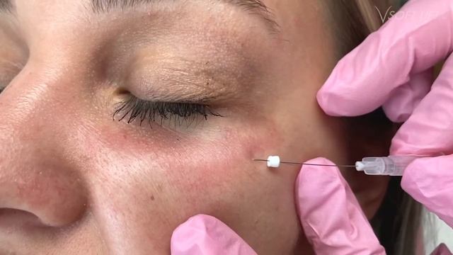 Smoothing the Tear Troughs with V Soft Lift Smoothing Threads смотреть онлайн