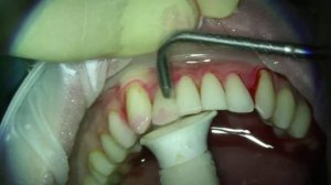 Lumiere Dental  Воздушно-абразивная обработка