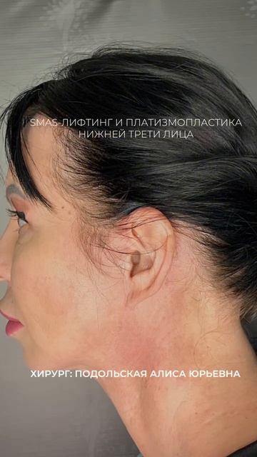 SMAS-лифтинг нижней трети лица + платизмопластика