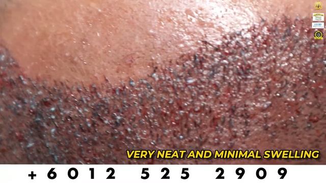 ( 1500 GRAFTS )IMMEDIATELY AFTER HAIR TRANSPLANT WITH SMART FUE TECHNIQUE | HAIR TRANSPLANT MALAYSI смотреть онлайн