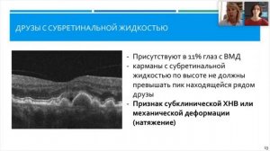 Сухая ВМД. ОКТ-признаки прогрессирования ВМД. Диагностика и терапия
