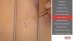 Техника наложения восьмиобразного шва