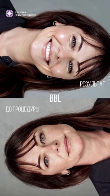 Фототерапия BBL до/после