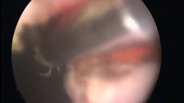 Greenlight XPS 180W Unedited Case Video Presentation 65g Prostate SIZE with MEDIAN LOBE- Trilobar смотреть онлайн