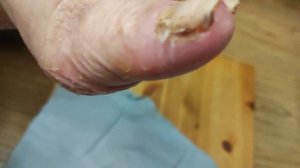 Ладонно подошвенный синдром