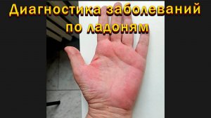 Диагностика заболеваний по ладоням