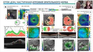 Практическая помощь ОКТ в дифдиагностике изменений при глаукоме и других патолог