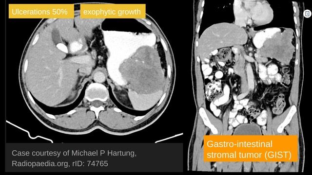 Gastric - Gastrointestinal stromal tumors (#GIST) #radiology #abr #core