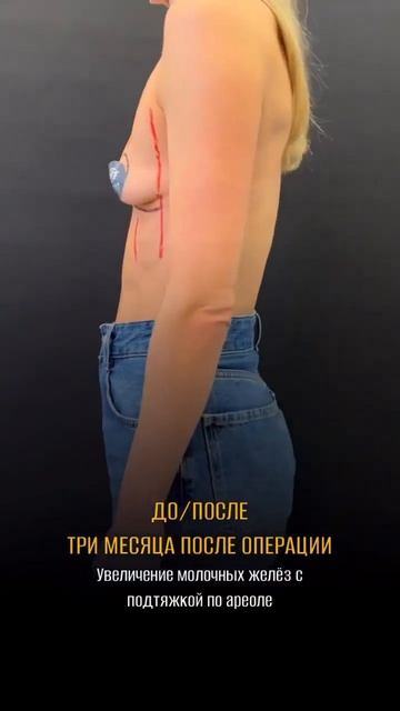 Маммопластика // Увеличение молочных желез с подтяжкой по ареоле // ДО - ПОСЛЕ #shorts
