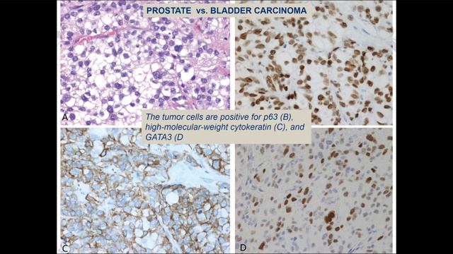 Practical update on classification of urothelial neoplasms - Dr. Parwani (Ohio State) #GUPATH
