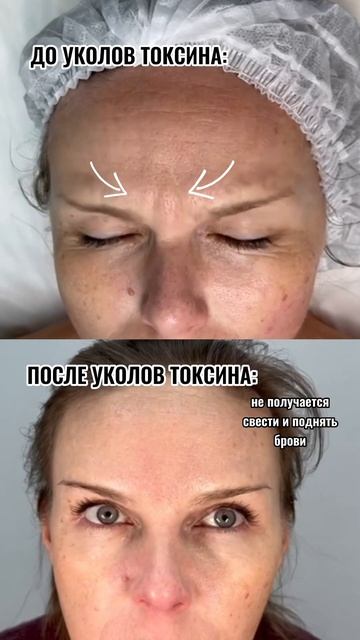 Морщины , после 40 лет возможно убрать только уколами ‼️ Инст@грам dr_vikavita  #уколыкрасоты
