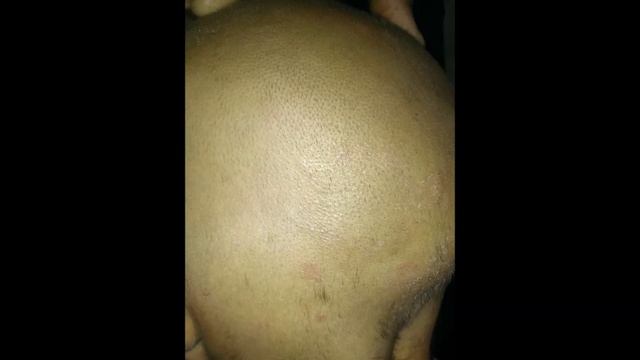 Tinea Capitis смотреть онлайн