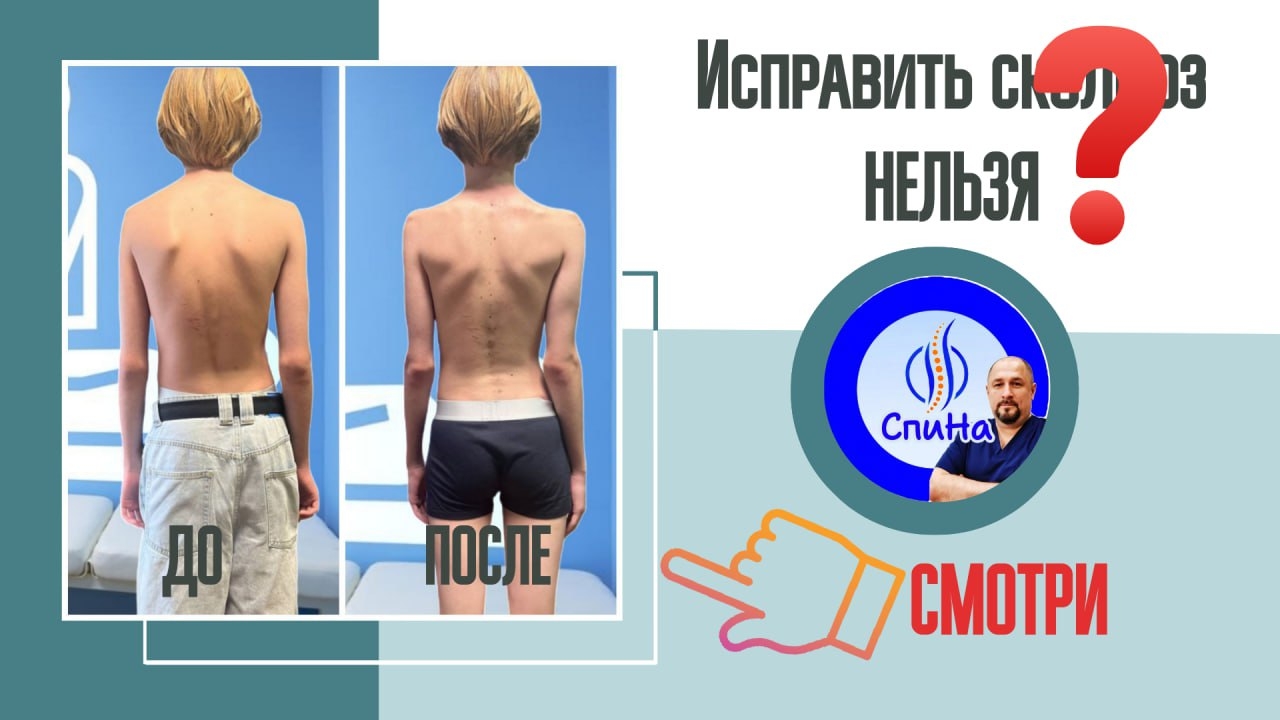 Результат работы со сколиозом #костоправмосква #здоровьеспины #сколиоз #осанка