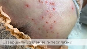 Удаление гиперплазий, клиника CLEAR Antiage