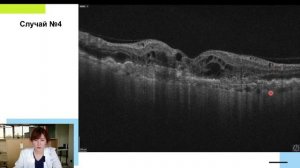 Взгляд сквозь слои_ эффективные подходы к анализу снимков ОКТ