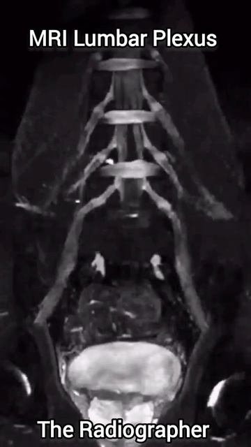 MRI Lumbar Plexus | #Spine #plexus #discbulge